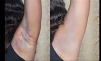 Remedies to help get rid of underarm darkness